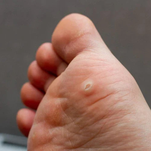 Why Wart Routines Often Fail (And What Makes Consistency So Hard)